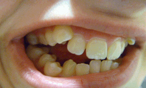  Crowding of teeth